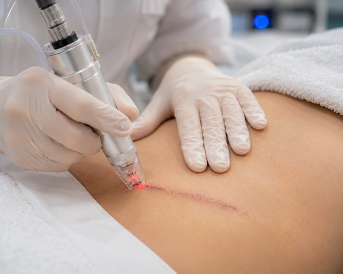 Practitioner performing Scar Treatment